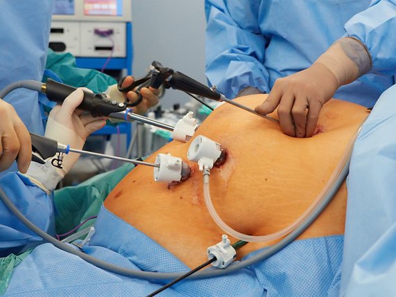chirurgie bariatrique